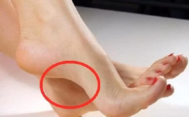 Bàn chân tướng thuyền úp