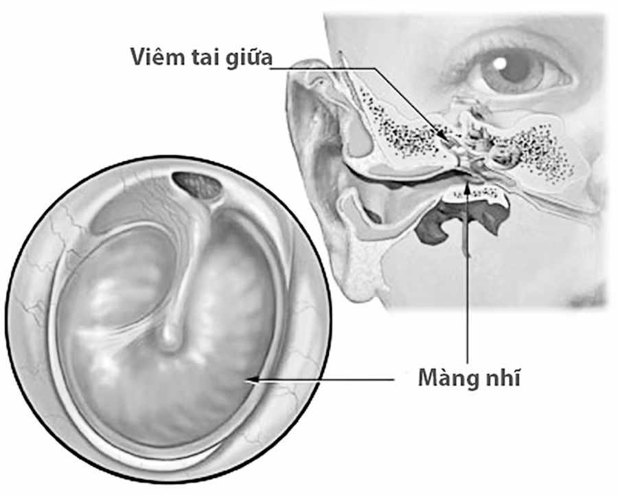 Viêm tai giữa cấp là bệnh nhiễm trùng khởi phát đột ngột, nguyên nhân phổ biến do vi khuẩn hoặc virus xâm nhập ở tai giữa. Ảnh minh họa
