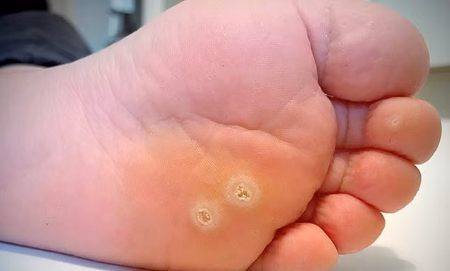 Đốt vết đen lạ vô tình kích thích tế bào ung thư di căn