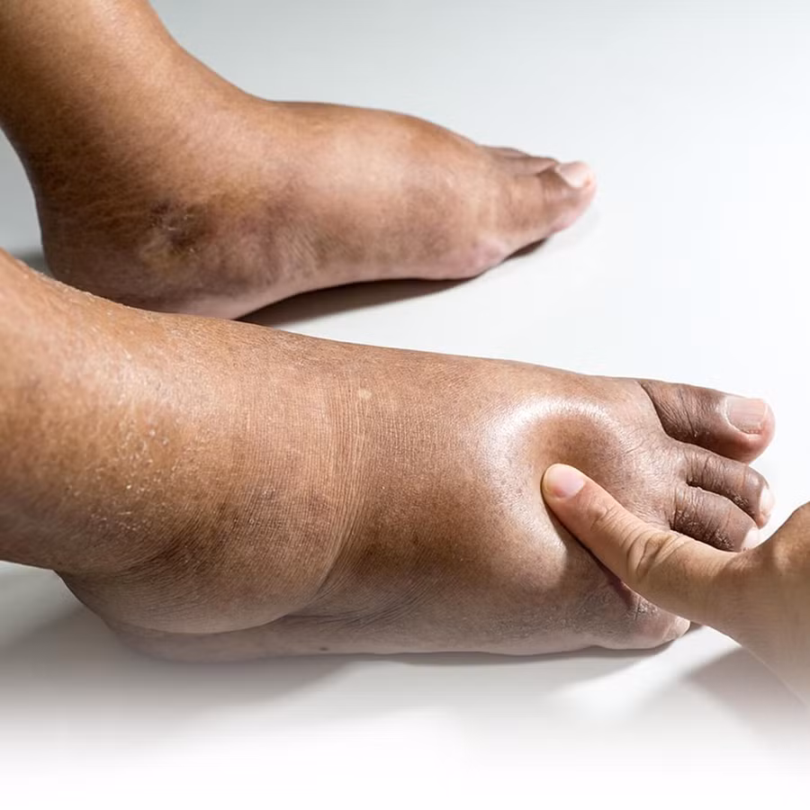 Biến chứng nguy hiểm của bệnh tiểu đường. Biến chứng nguy hiểm của bệnh tiểu đường.