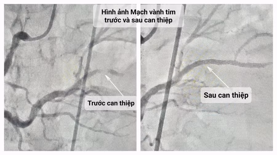 Hình ảnh mạch máu được tái thông sau can thiệp động mạch vành tim. Ảnh: BV. Hình ảnh mạch máu được tái thông sau can thiệp động mạch vành tim. Ảnh: BV.