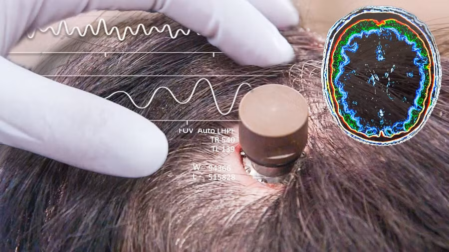 Minh họa chip được cấy vào não người.