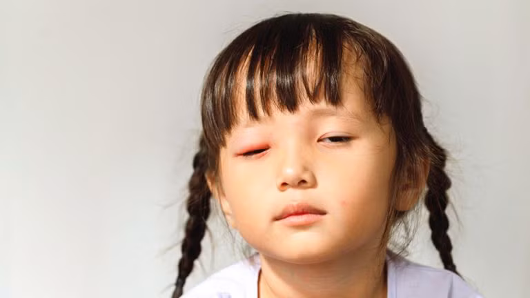 Trẻ bị đau mắt đỏ tuy lành tính nhưng cha mẹ không được chủ quan. Ảnh: ITN