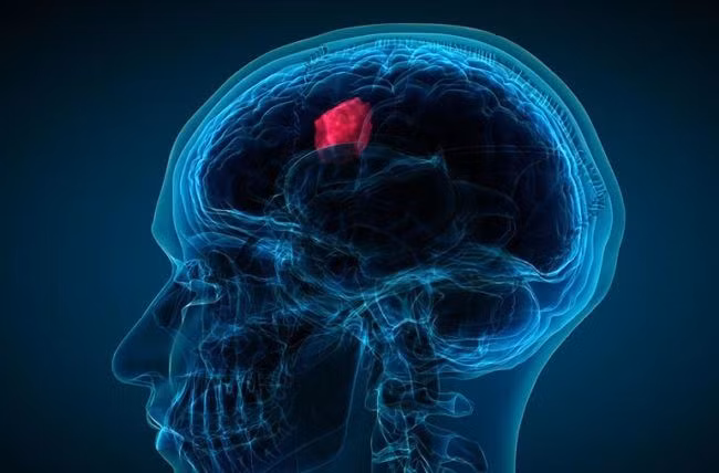 Cảnh báo biến chứng suy tuyến yên sau phẫu thuật u sọ hầu. (Ảnh: Minh họa).