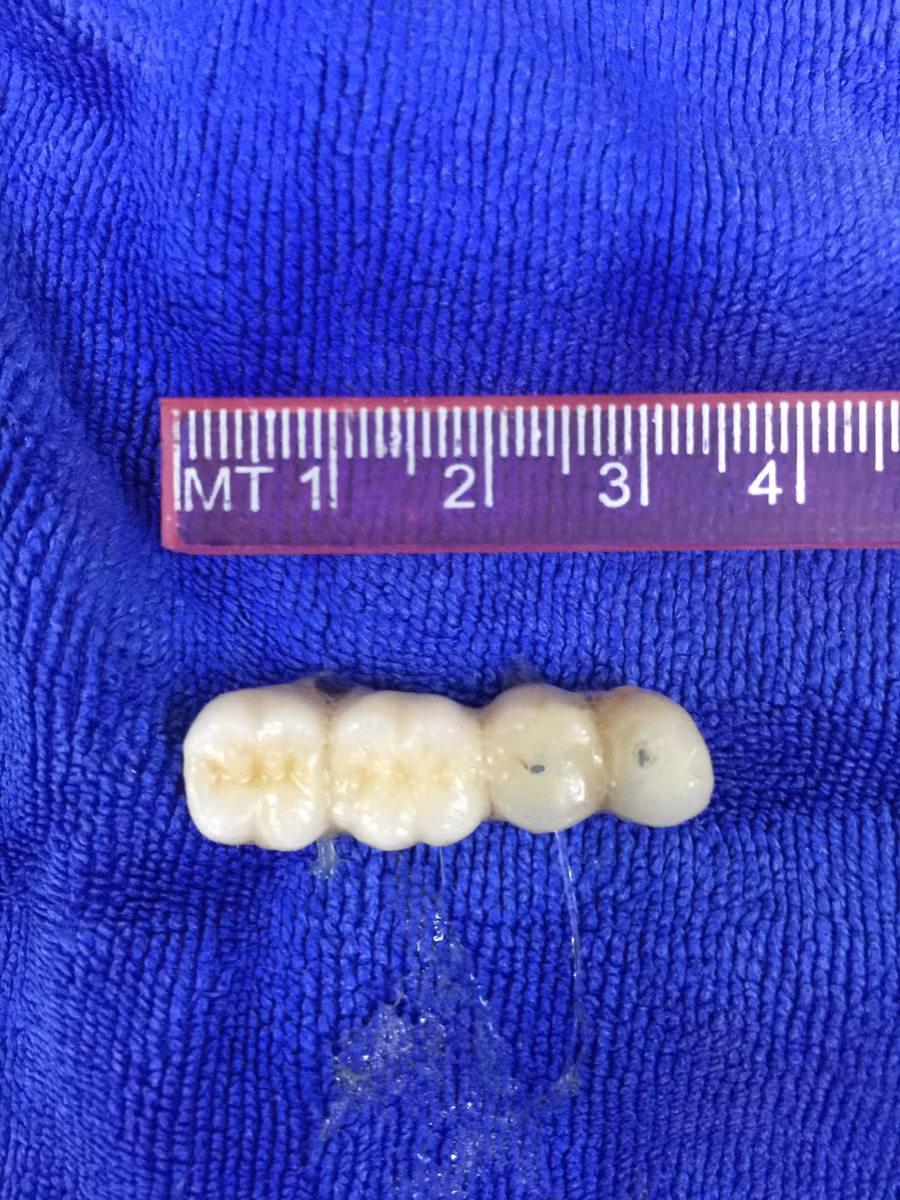 4 chiếc răng giả được bác sĩ gắp ra 4 chiếc răng giả được bác sĩ gắp ra