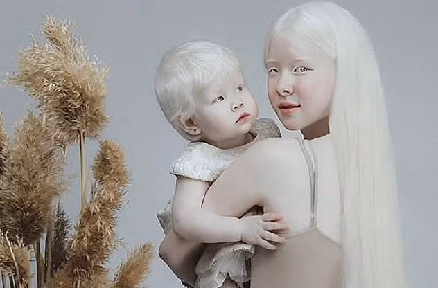 Diện mạo khác lạ của hai chị em bị bạch tạng “nổi như cồn” trên mạng xã hội 