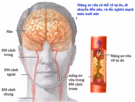 Thieu mau nao cuc bo thoang qua va dot quy - Anh 1
