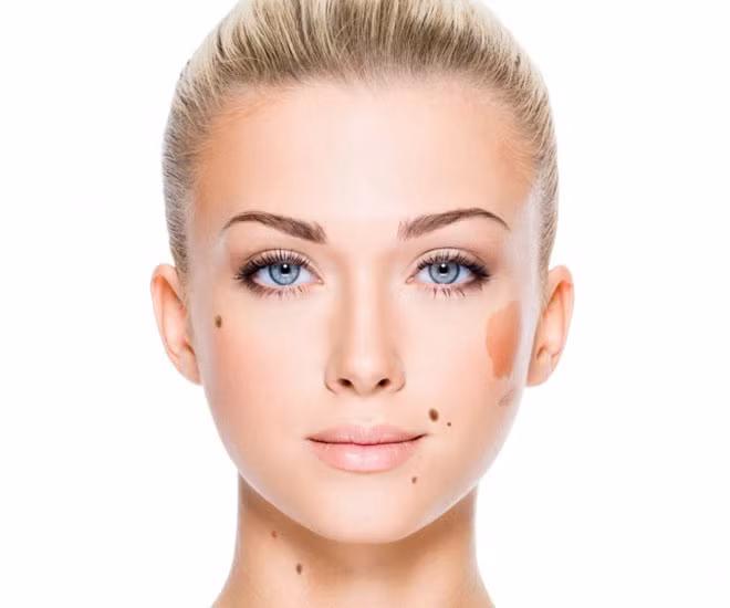 Nốt ruồi hoặc các vết bớt không rõ hình dạng xuất hiện bình thường thì không cần lo lắng. Tuy nhiên, nếu thấy viền ngoài của nốt ruồi bị rạn hoặc màu sắc không đồng đều, đường kính lớn hơn hạt đậu và có sự thay đổi trong vài tuần qua... thì bạn cần xem xét lại bởi nó có thể là dấu hiệu của ung thư.