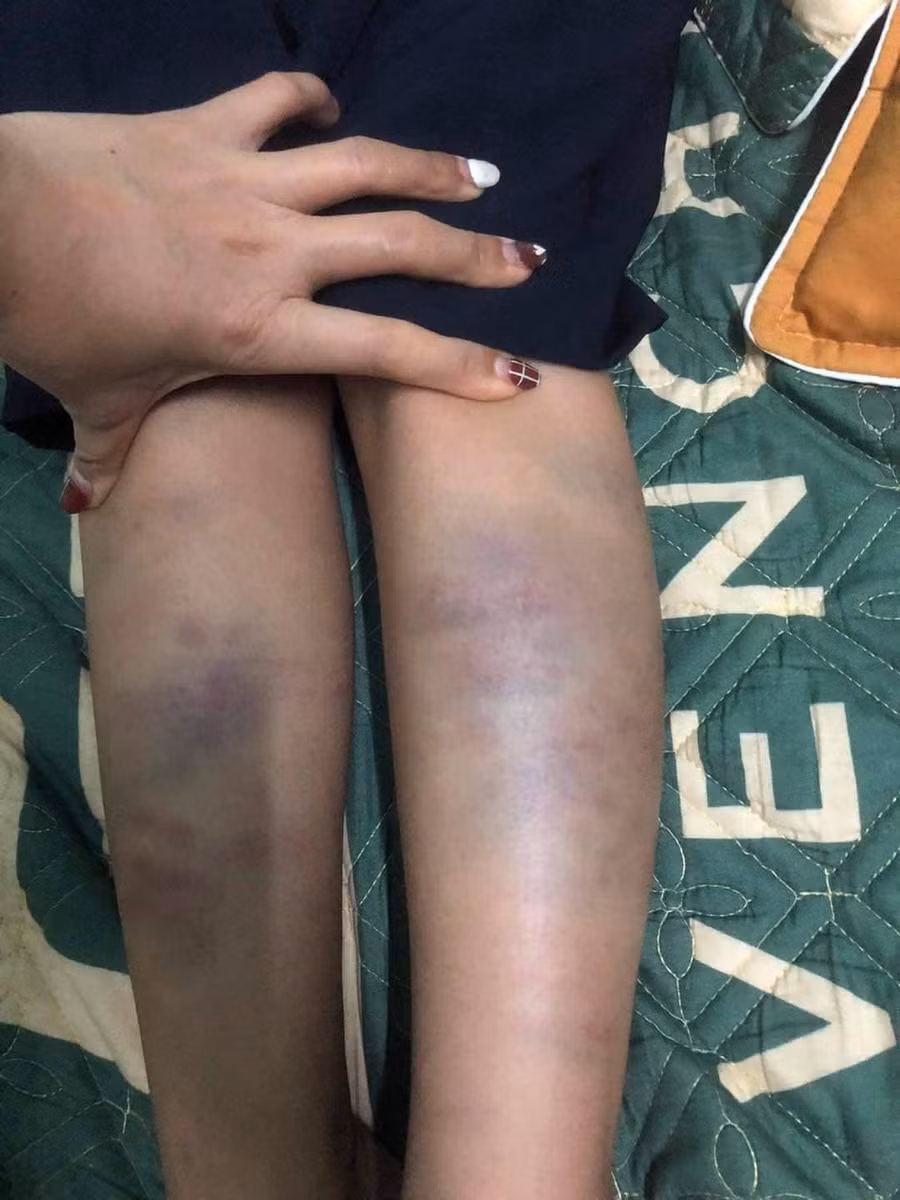 Vết bầm tím trên chân của em N.H.T.H. được phụ huynh chụp lại vào tối 5/10.