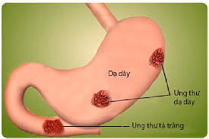 Cách phát hiện sớm ung thư đường tiêu hóa