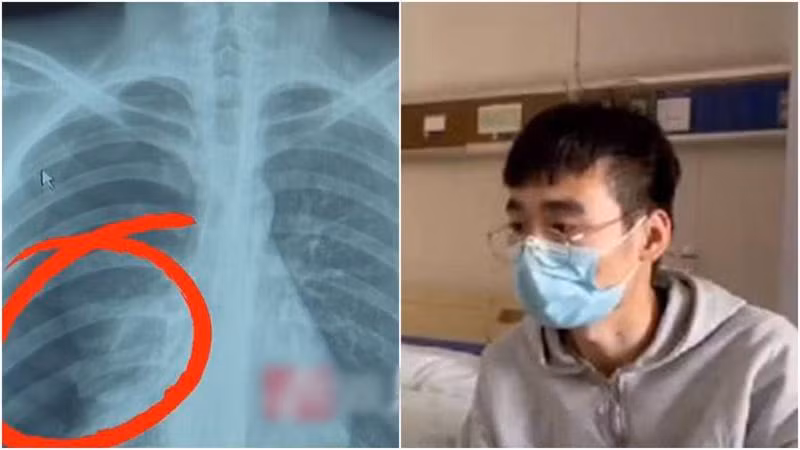 Người đàn ông bị vỡ phổi do hát karaoke.