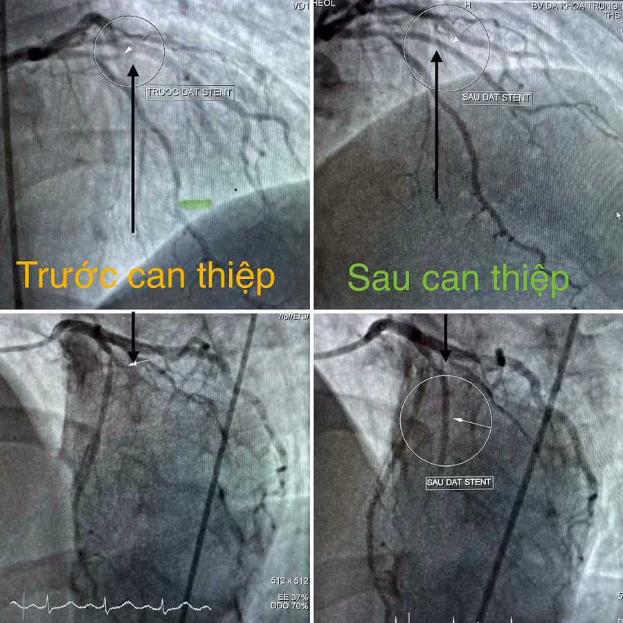 Bệnh viện Đa khoa Trung tâm An Giang cứu sống bệnh nhân người nước ngoài bị nhồi máu cơ tim cấp.
