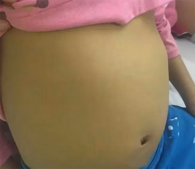 Chỉ sau 6 tháng ăn đồ ăn nhanh, Nana đã bị viêm gan với bụng phình to (Ảnh minh họa)