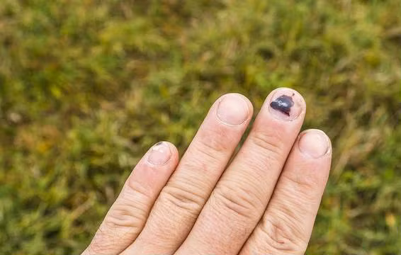 6 dấu hiệu khác lạ của móng tay tưởng đơn giản nhưng cực nguy hiểm ảnh 3