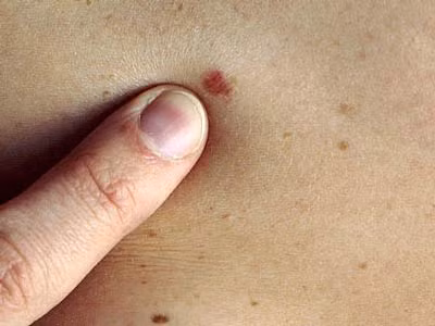 Dấu hiệu bất thường nào ở da cảnh báo ung thư?