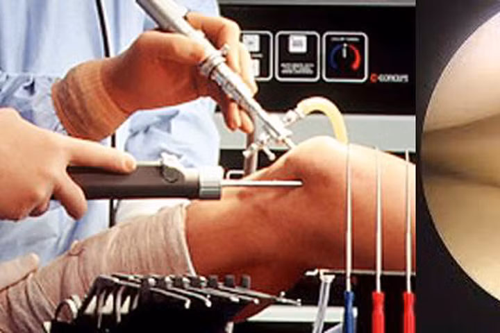 6 phương pháp phẫu thuật trị thoái hóa khớp gối