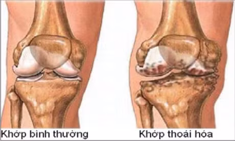 6 phuong phap phau thuat tri thoai hoa khop goi - Anh 1