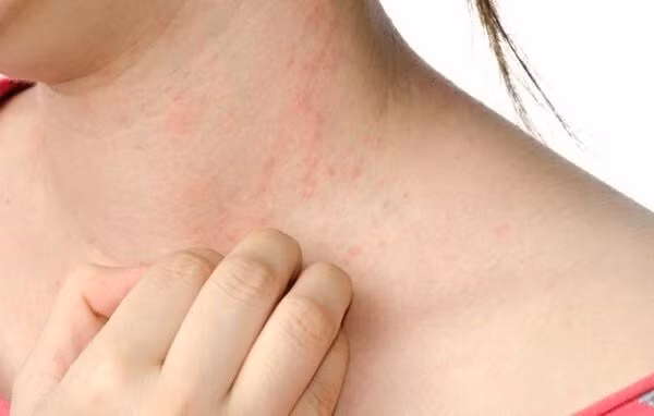 Biểu hiện viêm gan B gây ngứa da, nổi mẩn