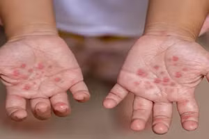 Bệnh tay chân miệng ở trẻ em - (Ảnh: Minh họa).