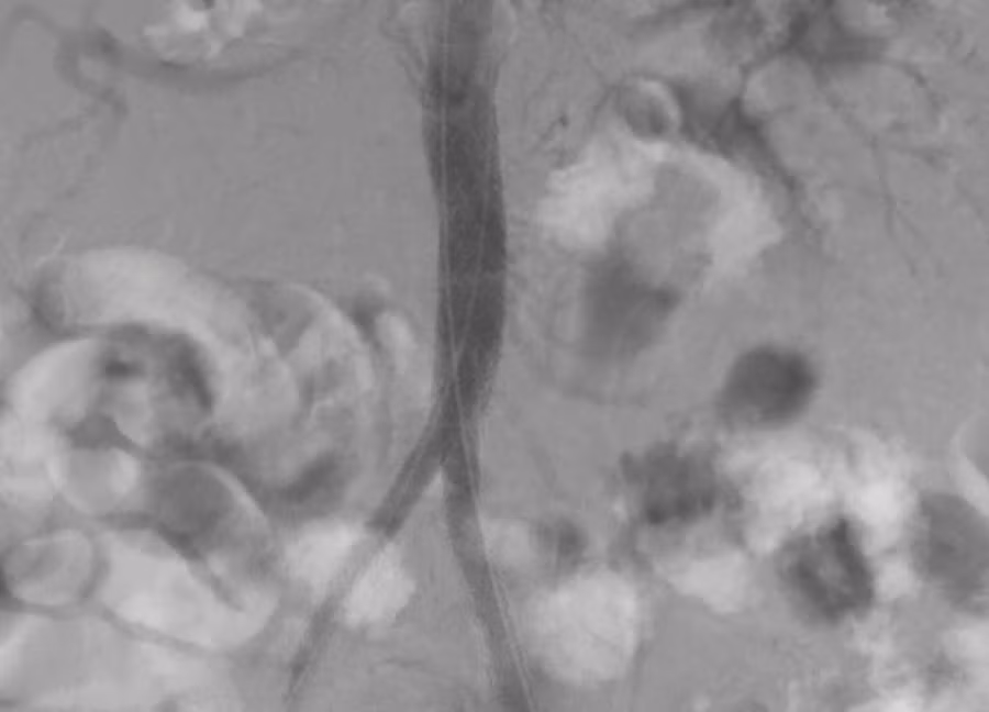 stent (1).jpg