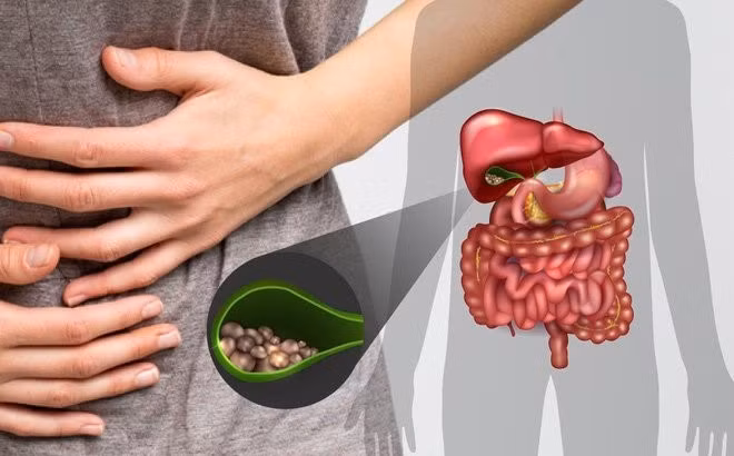 Biến chứng nguy hiểm của sỏi túi mật ảnh 1