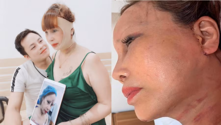 Nhan sắc "không tin nổi" của cô dâu 62 tuổi ở Cao Bằng sau 1 tháng phẫu thuật