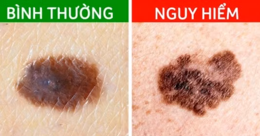 6 dấu hiệu nhận biết sớm nốt ruồi ác tính