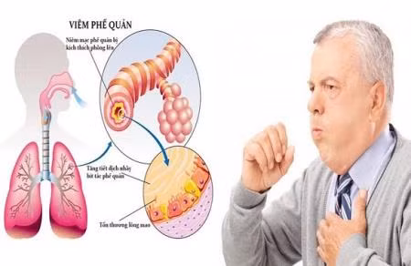 Cách kiểm soát biến chứng của bệnh phổi tắc nghẽn mạn tính