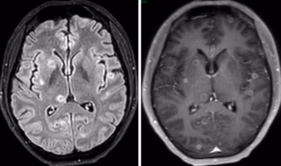 Hình ảnh MRI sọ não của người bệnh.