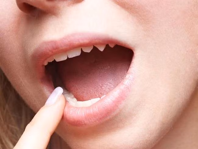 Cơ thể xuất hiện "1 cứng, 1 mềm" cảnh báo xuất huyết não ảnh 1