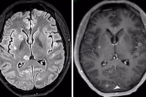 Hình ảnh MRI sọ não của người bệnh.