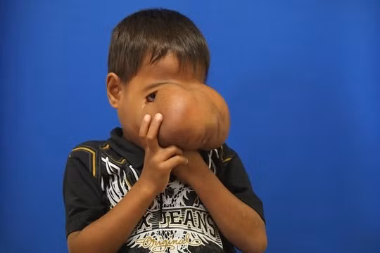 Cậu bé Jhonny Lameon trước khi được phẫu thuật